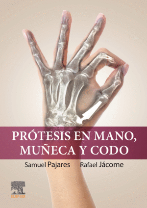 PROTESIS EN MANO MUÑECA Y CODO